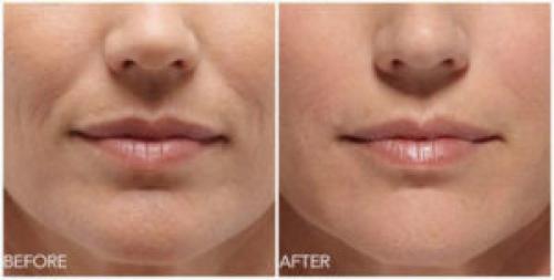 Как избавиться от носогубных складок косметология. 5 способов, как убрать носогубные складки