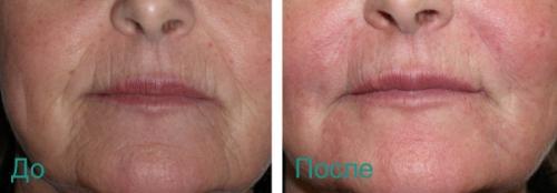 Как избавиться от носогубных складок в салоне. Удаление носогубных складок на лице