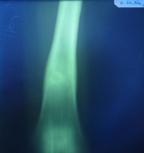 Истончение подвздошной кости. Клиническое наблюдение 1 03