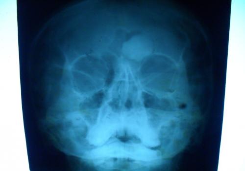 Истончение подвздошной кости. Клиническое наблюдение 1 02