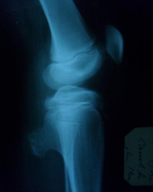 Истончение подвздошной кости. Клиническое наблюдение 1 01