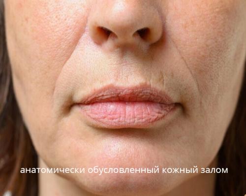 Как убрать мимические морщины. Внешние причины 04 Как убрать мимические морщины. Внешние причины 04