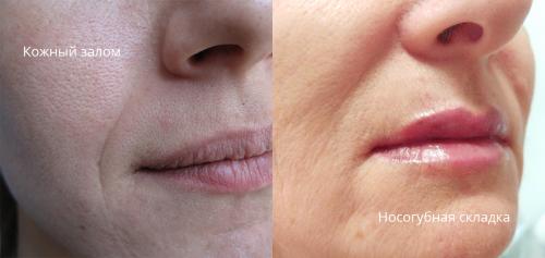 Как убрать мимические морщины. Внешние причины 02 Как убрать мимические морщины. Внешние причины 02