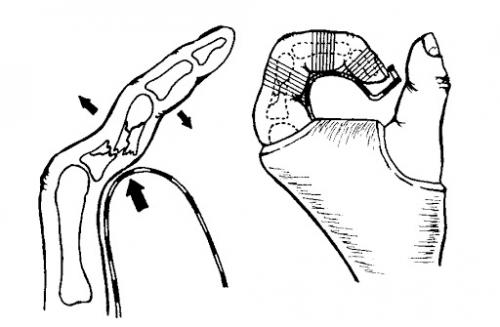 Фаланга пальца руки. Какие бывают переломы фаланг?