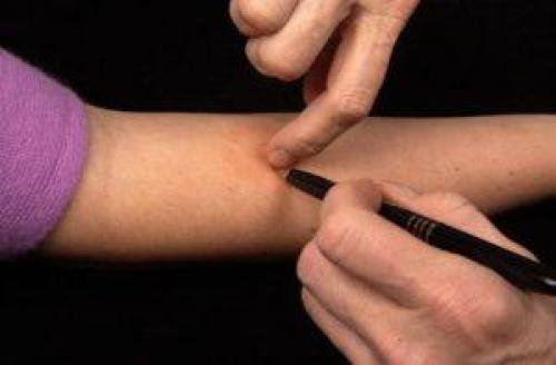 Какие продукты следует избегать после реакции Манту. Что такое проба Манту?