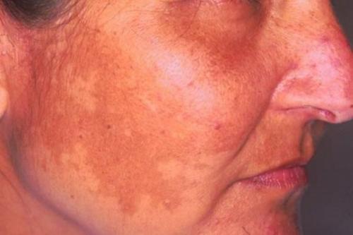 Как избавиться от пигментных пятен. Как избавиться от пигментации: тактика действий 08 Как избавиться от пигментных пятен. Как избавиться от пигментации: тактика действий 08