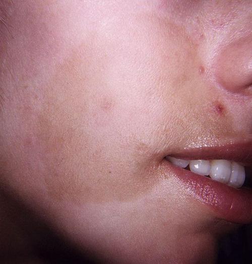 Как избавиться от пигментных пятен. Как избавиться от пигментации: тактика действий 13 Как избавиться от пигментных пятен. Как избавиться от пигментации: тактика действий 13