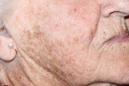 Как избавиться от пигментных пятен. Как избавиться от пигментации: тактика действий 12 Как избавиться от пигментных пятен. Как избавиться от пигментации: тактика действий 12