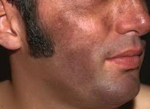 Как избавиться от пигментных пятен. Как избавиться от пигментации: тактика действий 14 Как избавиться от пигментных пятен. Как избавиться от пигментации: тактика действий 14