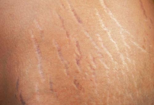 11 причин увеличения веса. Симптомы ожирения у детей 01