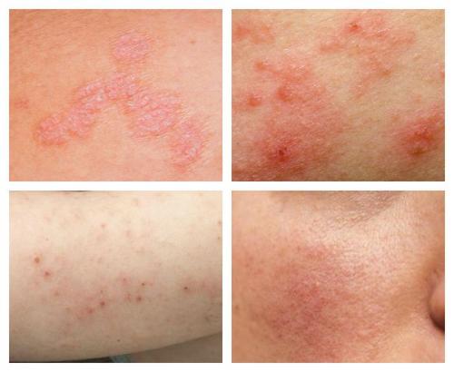 Что есть при дисбактериозе и кандидозе: полное руководство 01