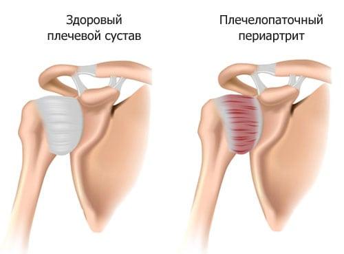 Хрустит плечо и болит. Плечелопаточный периартрит