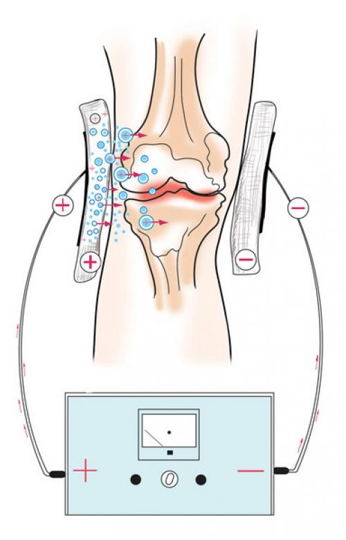 Электрофорез при артрите. Карипаин и Карипазим. Электрофорез Карипазима и Карипаина