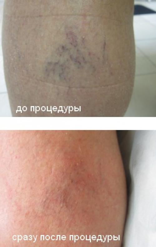 Удаление сосудов на лице. Лазерное удаление сосудов 02 Удаление сосудов на лице. Лазерное удаление сосудов 02