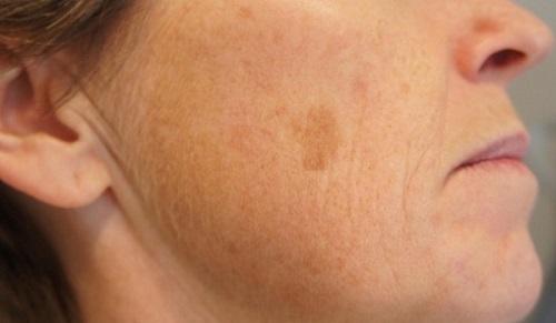 7 масок для удаления пигментных пятен и придания коже сияния. Как вывести пигментные пятна от солнца осветляющими средствами 02