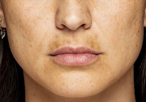 7 масок для удаления пигментных пятен и придания коже сияния. Как вывести пигментные пятна от солнца осветляющими средствами 03