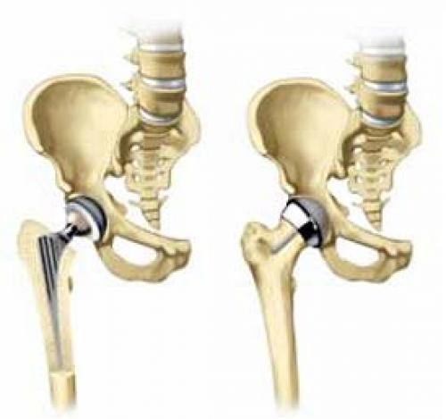 Эндопротезирование тазобедренного сустава по ОМС. Эндопротезирование тазобедренного или коленного сустава при наличии полиса ОМС 03