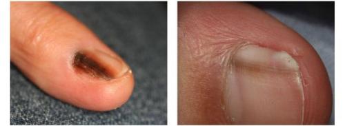 Что скрывается под черным пятном под кожей? Основные причины и симптомы 01 Что скрывается под черным пятном под кожей? Основные причины и симптомы 01