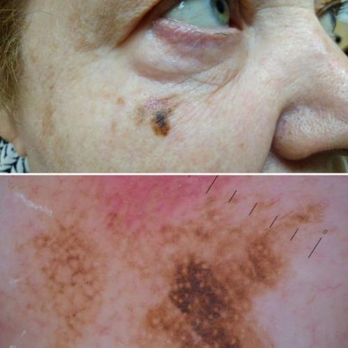 Что скрывается под черным пятном под кожей? Основные причины и симптомы 03 Что скрывается под черным пятном под кожей? Основные причины и симптомы 03