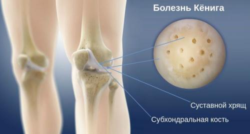 Чем опасно истощение хряща. Саркопения: связанные проблемы 01