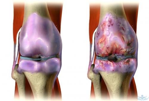 Пекут колени при артрозе. Артроз коленных суставов или гонартроз