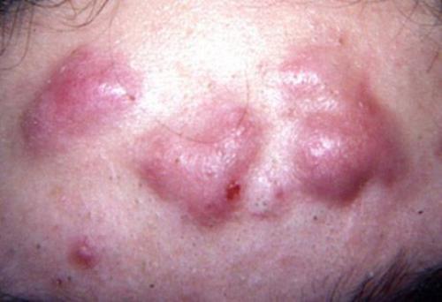 Закрытые комедоны на лице: что это такое и как с ними бороться 03