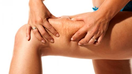 После антицеллюлитного массажа стало хуже. Откуда берётся целлюлит