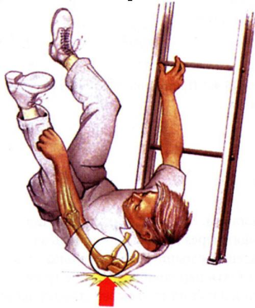 Растяжение мышц и сухожилий первая помощь. Оказание первой помощи при травмах опорно-двигательного аппарата