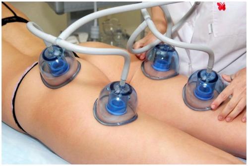 Как самостоятельно делать баночный массаж от целлюлита. Как делать вакуумный массаж тела в домашних условиях? 03