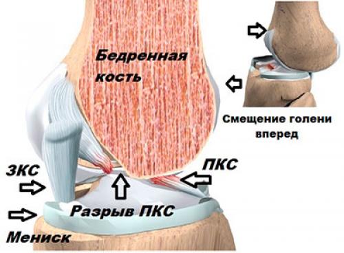 Субтотальный разрыв мышцы. Разрыв крестообразной связки колена. Передняя крестообразная связка коленного сустава разрыв. Субтотальное повреждение ПКС.