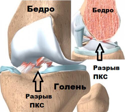 Полный разрыв передней крестообразной. Парциальный разрыв крестообразной связки коленного сустава. Разрыв передней крестообразной связки (ПКС). Субтотальный разрыв крестообразной связки. Субтотального крестообразная связка коленного сустава.