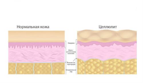 Как избавиться от целлюлита 4 стадии и все методики борьбы. Как избавиться от целлюлита на животе 05