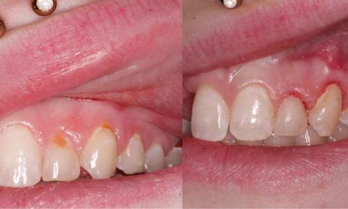 Как избавиться от черных точек на зубах. Почему черный кариес не всегда лечат на начальной стадии?