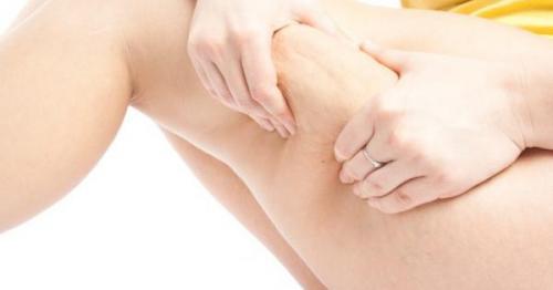 Как избавиться от целлюлита в домашних условиях. 7 шагов в борьбе с целлюлитом