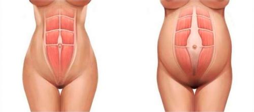 Живот после кесарева сечения. Диастаз живота после кесарева сечения 03