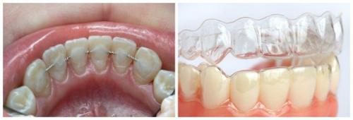 Смещение челюстного сустава. Анатомия ВНЧС 02