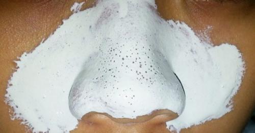 Как выдавить черные точки на носу. Давить или не давить?