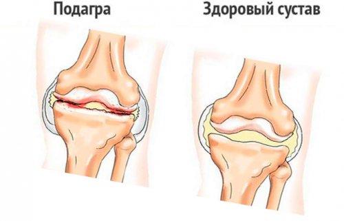 Горячие колени причины. Ноют колени 01 Горячие колени причины. Ноют колени 01