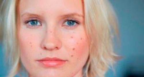 Как избавиться от черных точек на носу. Причины появления черных точек на лице 12