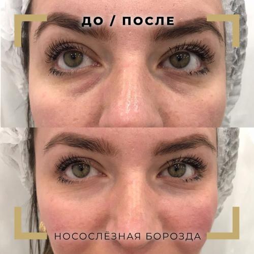 Как называется процедура удаление мешков под глазами. Что такое безоперационная блефаропластика