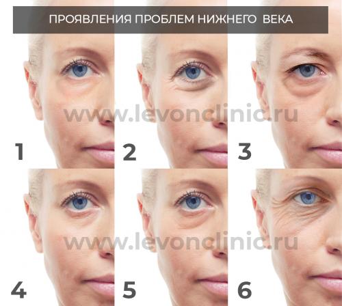 Аппаратная косметология против мешков под глазами. Клиническая оценка 02