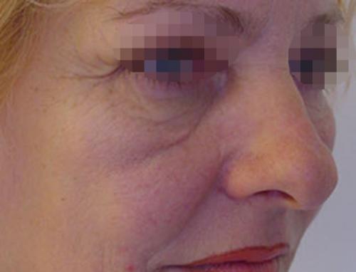 Как избавиться от темных кругов под глазами форум. Вопрос: Малярные мешки.