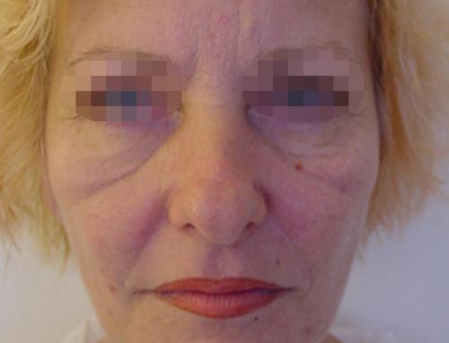 Как избавиться от темных кругов под глазами форум. Вопрос: Малярные мешки.