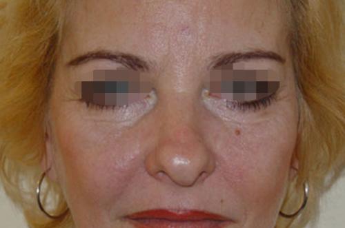 Как я избавилась от малярных мешков. Вопрос: Малярные мешки.