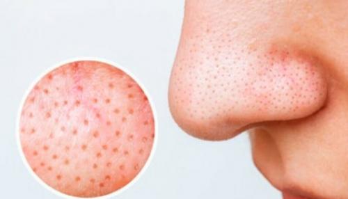 Что такое черные точки на лице. Что такое черные точки?