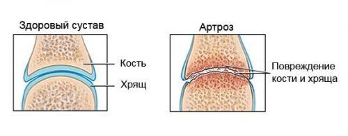 Как касторовое масло влияет на суставы рук. Касторовое масло для здоровых и крепких суставов