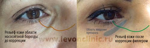 От темных кругов под глазами в домашних условиях. Реально работающие способы убрать тёмные круги.