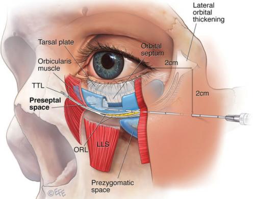 Убрать темные круги под глазами у косметолога. Как убрать круги филлерами.