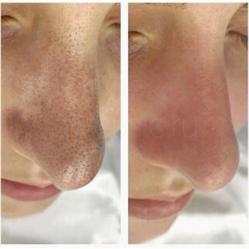 Отказаться от черных точек на носу: лучшие средства и методы 13