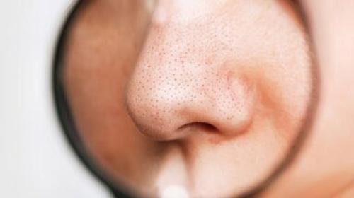 Отказаться от черных точек на носу: лучшие средства и методы 11